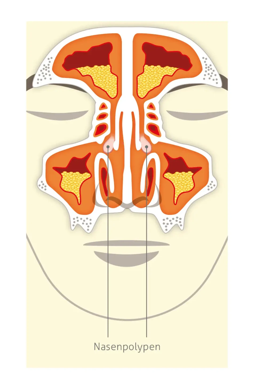 Medizinische Illustration eines Querschnitts durch Nase und Nasennebenhöhlen, die beidseitige Nasenpolypen zeigt. Die Polypen blockieren die Luftwege. Es wird gelblicher Schleimüberschuss symmetrisch in den orangefarbenen Nasennebenhöhlen dargestellt. Die entzündete geschwollene Schleimhaut ist dunkelrot umrandet.Am unteren Bildrand steht der der Text "Nasenpolypen".