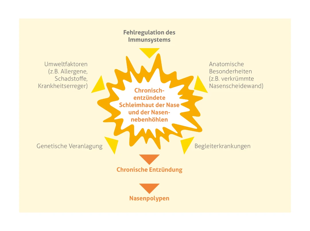 Infografik zu Faktoren, welche zu chronisch entzündeter Schleimhaut der Nase und Nasennebenhöhlen führt (Zentrum der Grafik, orange eingekreist) Hauptüberschrift: "Fehlregulation des Immunsystems" mit darunter angeführten Faktoren: 'Anatomische Besonderheiten (z.B. verkürzte Nasenscheidewand)', 'Begleiterkrankungen','Umweltfaktoren (z.B. Allergene, Schadstoffe, Krankheitserreger)' und 'Genetische Veranlagung'. Diese Faktoren münden schließlich am unteren Ende der Grafik in chronischer Entzündung und Nasenpolypen.