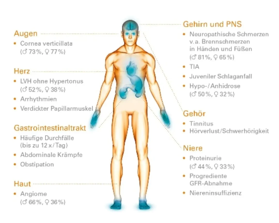 Anatomisches Diagramm, das Morbus-Fabry- Symptome und ihre Prävalenz nach Geschlecht in verschiedenen Körpersystemen zeigt, einschließlich Augen (Cornea verticillata), Herz (LVH), Magen-Darm- Trakt, Haut (Angiome), Gehirn, peripheres Nervensystem und Nieren.