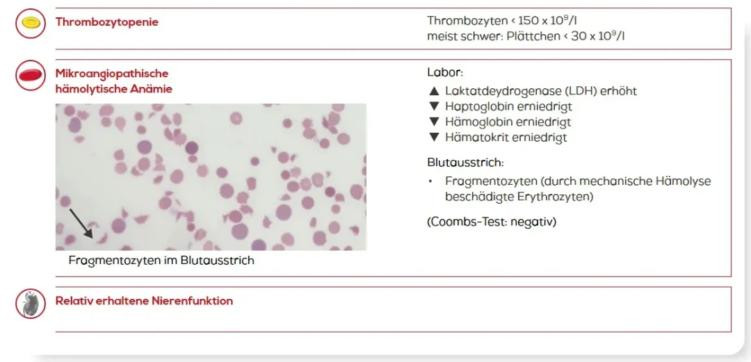Laborbefunde bei TTP mit Thrombozytopenie, mikroangiopathischer hämolytischer Anämie mit mikroskopischem Bild von Fragmentozyten und weiteren Laborparametern wie erhöhter LDH, erniedrigtem Haptoglobin und negativem Coombs- Test, wobei die Nierenfunktion relativ erhalten ist.