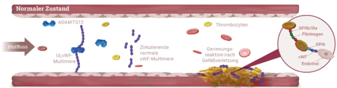 Ein Vergleichsdiagramm, das den normalen Blutzustand und den Zustand bei erworbener TTP zeigt. Es illustriert, wie ADAMTS13 normalerweise vWF-Multimere spaltet und wie antikörpergebundenes ADAMTS13 zur Bildung von Mikrothromben bei TTP führt.