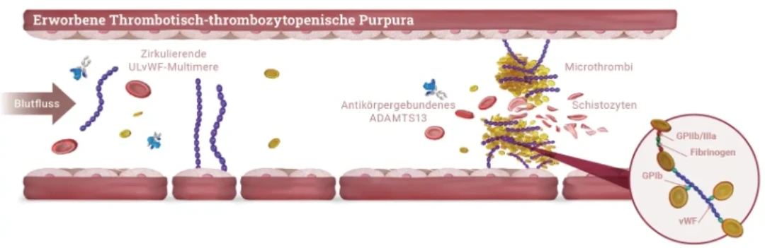 Ein Vergleichsdiagramm, das den normalen Blutzustand und den Zustand bei erworbener TTP zeigt. Es illustriert, wie ADAMTS13 normalerweise vWF-Multimere spaltet und wie antikörpergebundenes ADAMTS13 zur Bildung von Mikrothromben bei TTP führt.