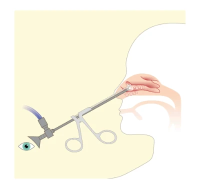 Eine illustrative Darstellung einer endoskopischen Untersuchung der Nase und der Nasennebenhöhlen. An einem Ende des Endoskops ist ein Auge dargstellt, am anderen Ende befindet sich das beleuchtete flexible Rohr innerhalb der Nase.