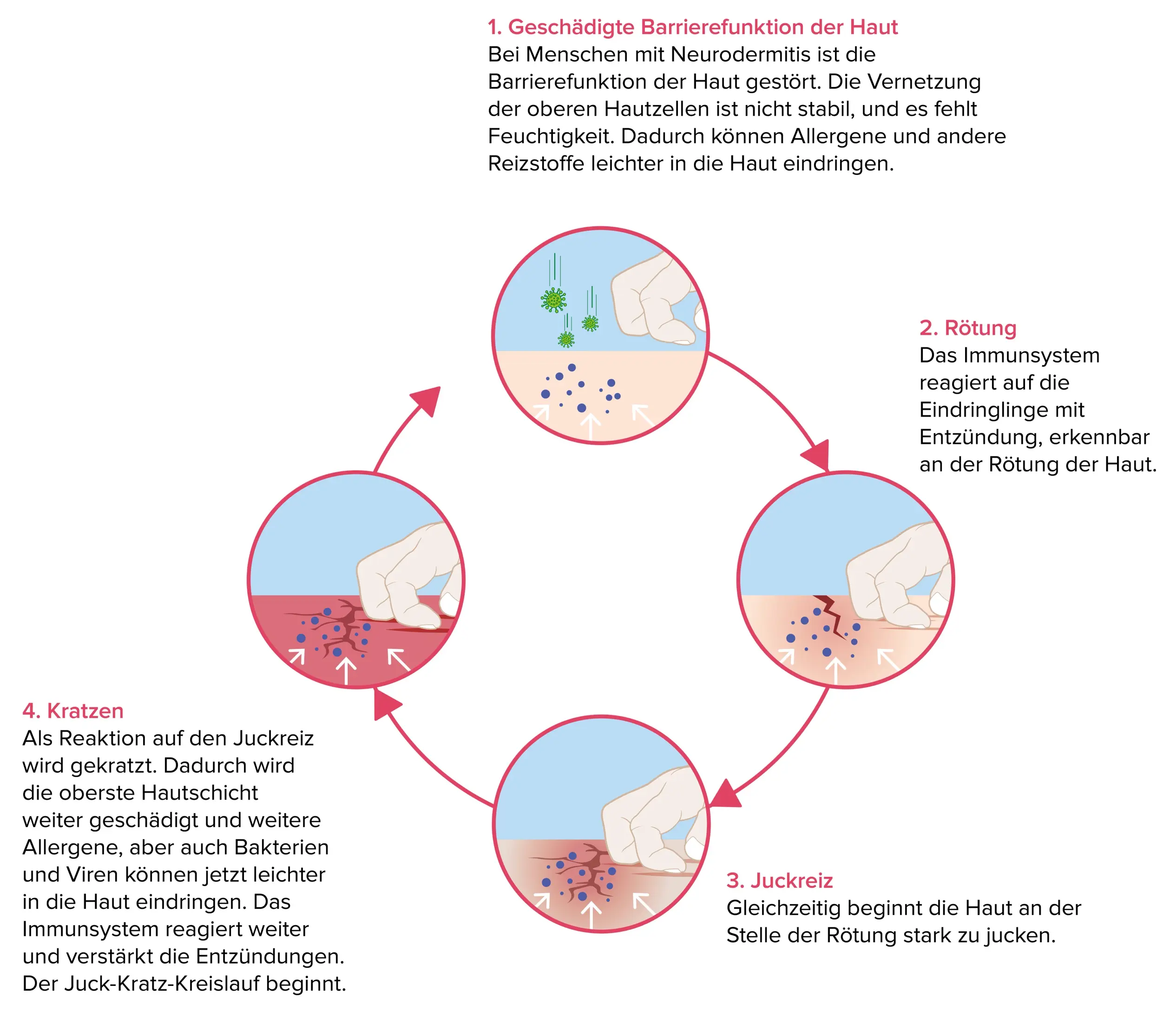 Diagramm des vierstufigen Juckreiz-Kratz-Zyklus bei Neurodermitis: 1) Geschädigte Barrierefunktion der Haut - Feuchtigkeit entweicht, während Reizstoffe und Allergene in die Haut eindringen; 2) Rötung - Immunsystem reagiert auf Reizstoffe mit Hautrötung; 3) Juckreiz - die Haut beginnt zu jucken, was den Zyklus einleitet; 4) Kratzen - Reaktion auf Juckreiz schädigt die Haut weiter, ermöglicht das Eindringen weiterer Allergene und Bakterien, wodurch das Immunsystem erneut mit verstärkter Rötung reagiert. Pfeile verbinden alle Schritte in einem kreisförmigen Muster und veranschaulichen den kontinuierlichen Zyklus.