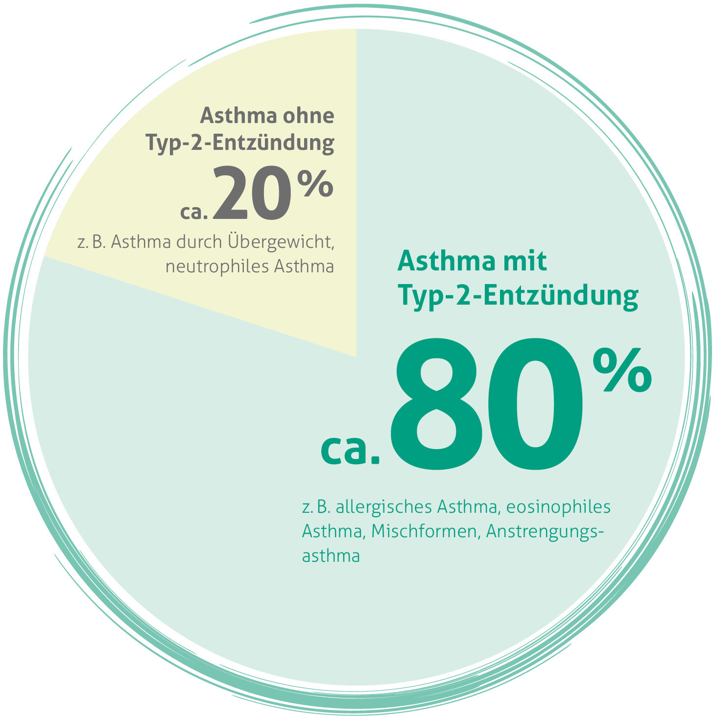 Kreisdiagramm zur Verteilung von Asthma-Typen: 80% ist Asthma mit Typ-2-Entzündung (einschließlich allergisches Asthma, eosinophiles Asthma, Mischformen und Anstrengungsasthma) und 20% ist Asthma ohne Typ-2-Entzündung (einschließlich Asthma durch Übergewicht und neutrophiles Asthma).