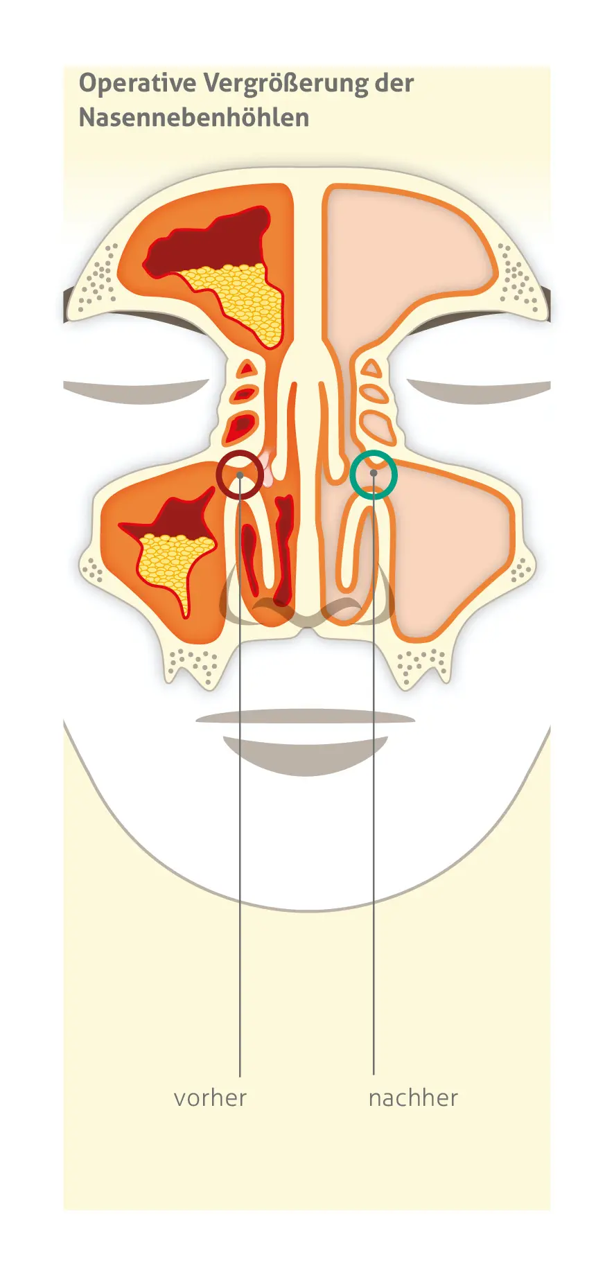 Anatomische Illustration der operativen Eröffnung der Nasennebenhöhlen mit Vorher-Nachher-Vergleich. Die linke Seite zeigt verengte, mit Schleim gefüllte Nebenhöhlen vor der Operation, während die rechte Seite erweiterte, offenere Nebenhöhlen mit verbessertem Luftstrom nach dem Eingriff darstellt. Der Bereich des chirurgischen Eingriffs ist mit einem grünen Kreis hervorgehoben.