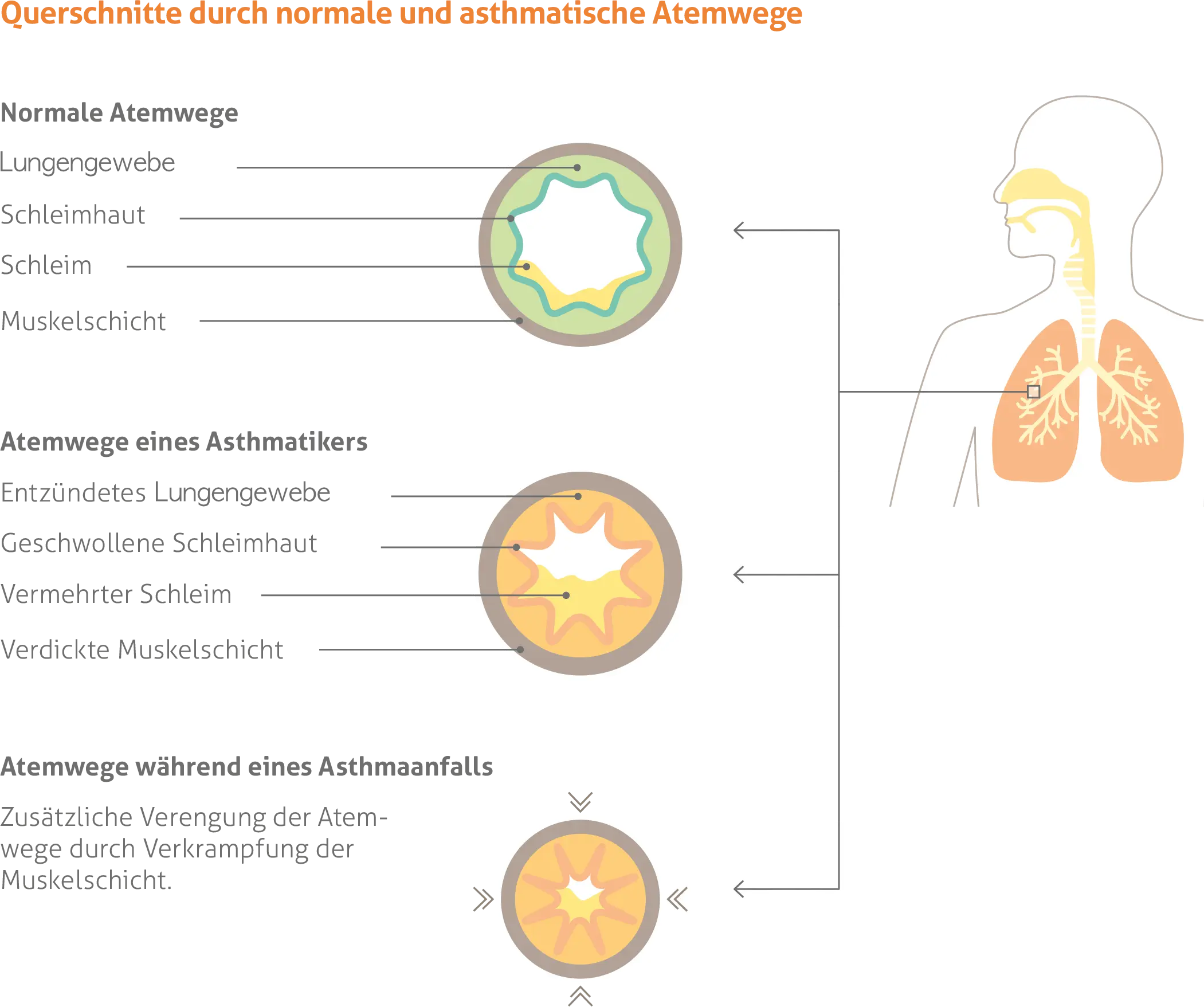 Diagramm mit Querschnitten normaler und asthmatischer Atemwege. Zeigt drei Stadien: 1) Normale Atemwege mit regulärem Bronchialgewebe, Schleimhaut, Schleim und Muskelschicht; 2) Atemwege eines Asthmatikers mit entzündetem Bronchialgewebe, geschwollener Schleimhaut, vermehrtem Schleim und verdickter Muskelschicht; 3) Atemwege während eines Asthmaanfalls mit zusätzlicher Verengung durch Verkrampfung der Muskelschicht.