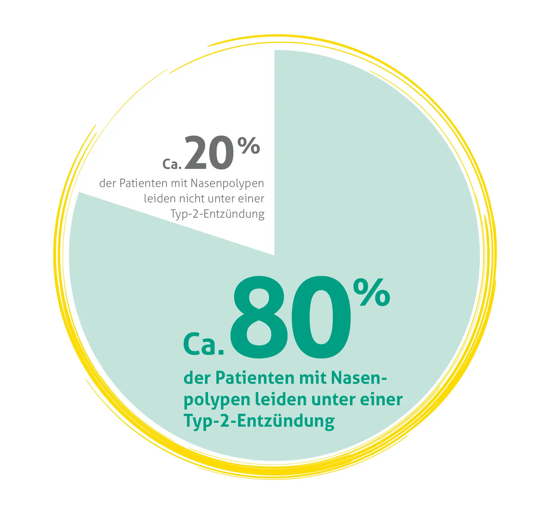 Kreisdiagramm zur Verteilung von Patienten mit Nasenpolypen: Ein größeres hellblaues Segment zeigt, dass ca. 80% der Patienten mit Nasenpolypen unter einer Typ-2-Entzündung leiden. Ein kleineres weißes Segment zeigt, dass ca. 20% der Patienten mit Nasenpolypen nicht unter einer Typ-2-Entzündung leiden.