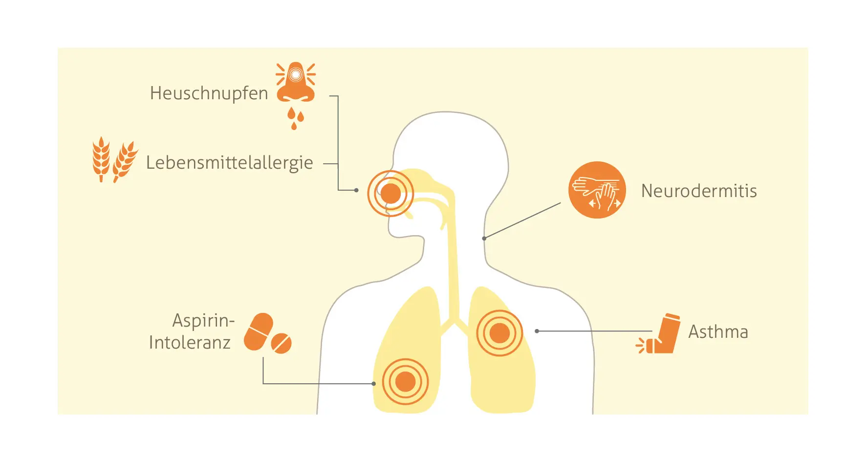 Grafische Darstellung der Begleiterkrankungen bei chronischer Rhinosinusitis mit Nasenpolypen. Eine menschliche Silhouette in der Mitte zeigt die betroffenen Körperbereiche mit roten Kreisen. Links oben: Heuschnupfen (tropfende Nase-Symbol) und Lebensmittelallergie (Weizen-Symbol). Rechts: Neurodermitis (Hand mit roter Flamme). Unten links: Aspirin-Intoleranz (rote Pillen-Symbole). Unten rechts: Asthma (Inhalator-Symbol), das Brust und Lunge betrifft."
