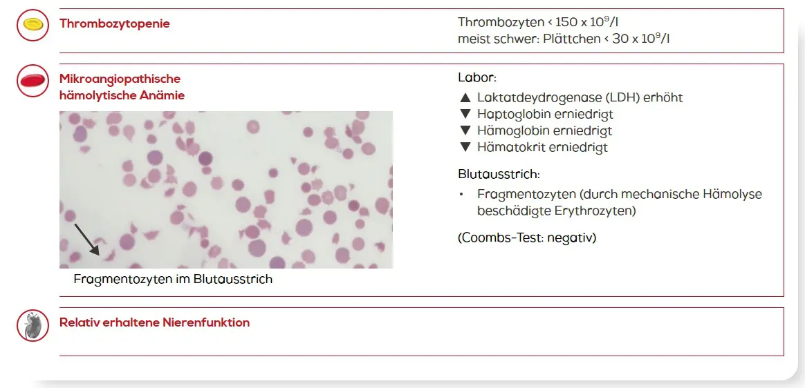 Laborbefunde bei TTP mit Thrombozytopenie, mikroangiopathischer hämolytischer Anämie mit mikroskopischem Bild von Fragmentozyten und weiteren Laborparametern wie erhöhter LDH, erniedrigtem Haptoglobin und negativem Coombs- Test, wobei die Nierenfunktion relativ erhalten ist.