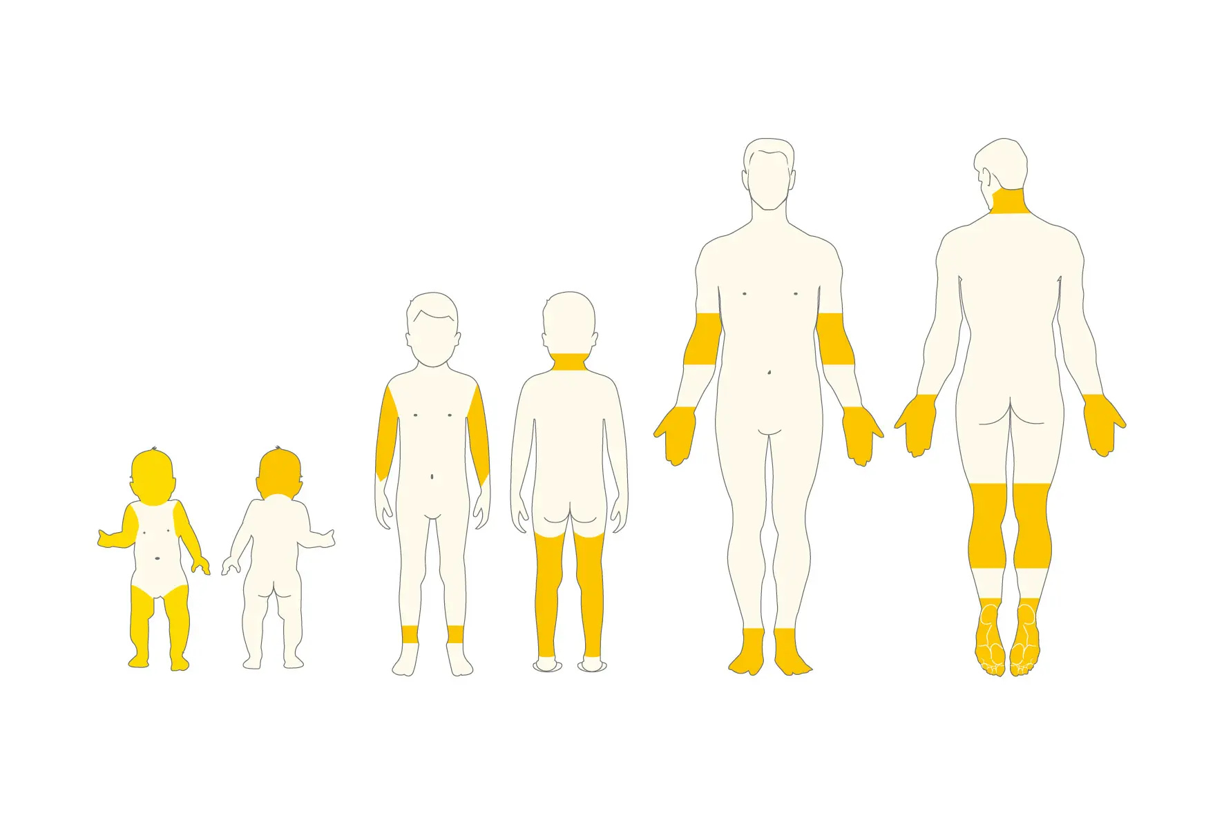 Diagramm zur Darstellung der Körperoberfläche (BSA) über sechs Altersgruppen vom Säugling bis zum Erwachsenen. Jede menschliche Figur ist gelb schattiert, um den Anteil der betroffenen Körperoberfläche in verschiedenen Entwicklungsstadien anzuzeigen, wobei die betroffene Fläche bei Säuglingen im Verhältnis zu Erwachsenen prozentual größer ist, auch wenn die absolute Fläche mit dem Körperwachstum zunimmt.