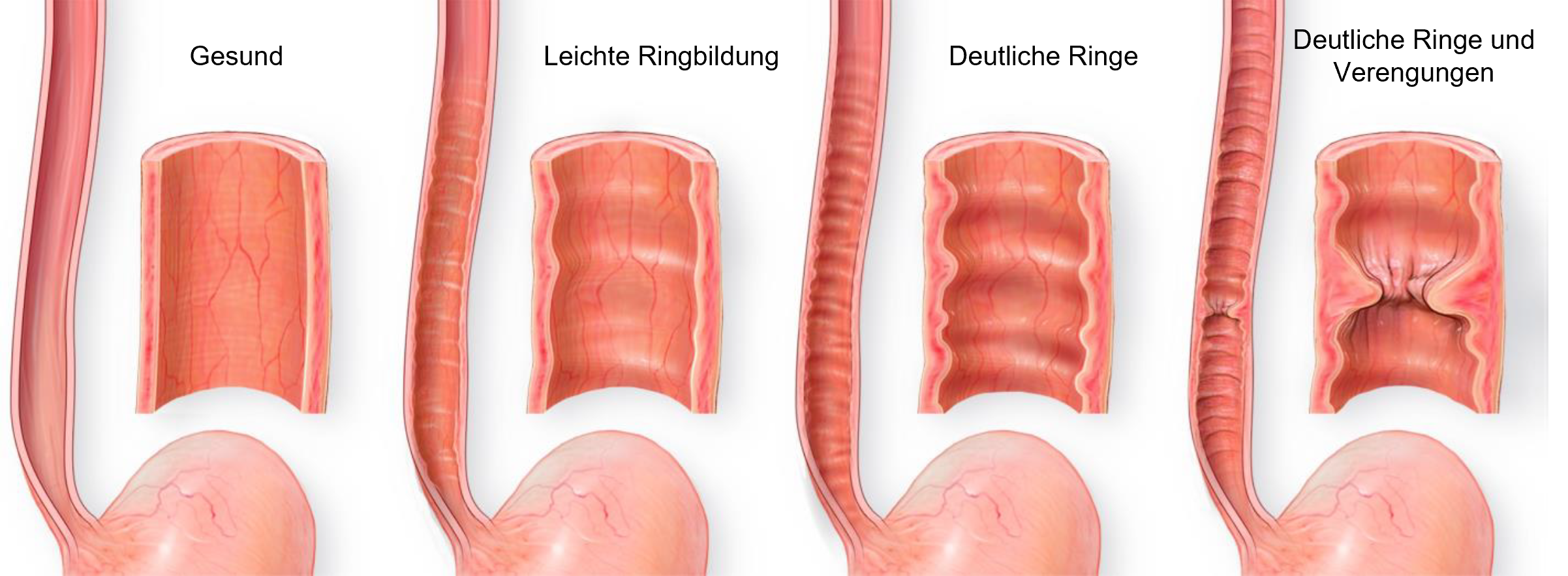 Infografik zur eosinophilen Ösophagitis mit vier Bildern, die den Krankheitsverlauf von gesunder Speiseröhre über Ringbildung bis hin zu Verengungen zeigt, mit begleitendem Text zu Symptomen und Ursachen.
