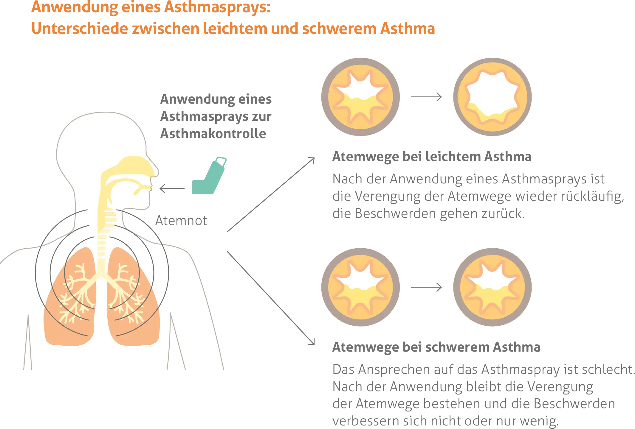 Diagramm zum Vergleich der Wirksamkeit eines Asthmasprays bei leichtem versus schwerem Asthma. Zeigt eine menschliche Figur, die einen Inhalator benutzt, mit zwei Sätzen von Atemwegsdarstellungen. Bei leichtem Asthma: Atemwege erweitern sich deutlich nach Anwendung des Sprays, Beschwerden gehen zurück. Bei schwerem Asthma: Atemwege bleiben nach Anwendung des Sprays verengt mit geringer oder keiner Verbesserung der Symptome. Titel lautet 'Anwendung eines Asthmasprays: Unterschiede zwischen leichtem und schwerem Asthma.'